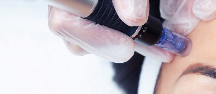 Microneedling treatment